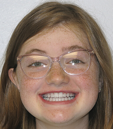 Young girl smiling after pediatric orthodontics