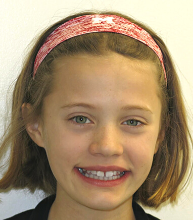 Preteen girl smiling before braces