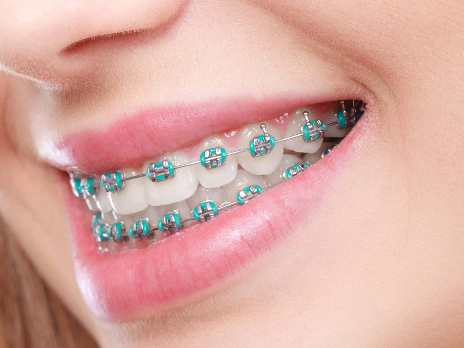 Spring Cleaning Tips For Braces Milton Braces Care Milton Orthodontics